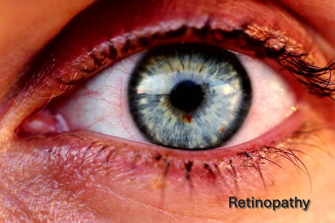 Solar Retinopathy